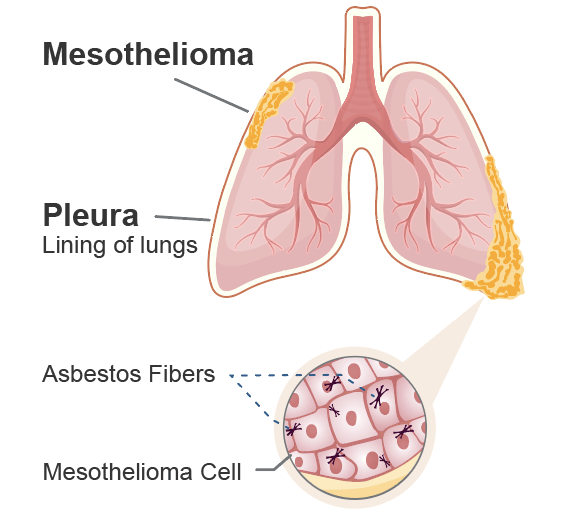 Mengenali Penyakit Mesothelioma Dan Penyebab Sampai Cara Menyembuhkannya